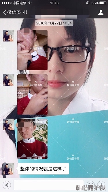 臉上長痘痘怎么去掉？徹底告別痘痘，自卑到自信的蛻變！