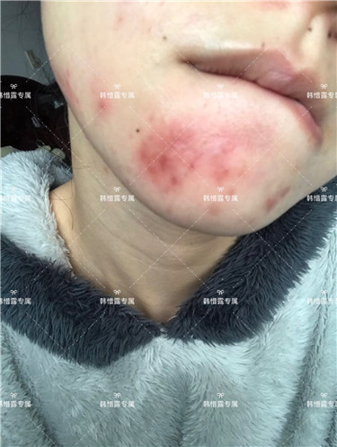 【視頻】臉上長粉刺怎樣去掉？醫院都沒搞定韓惜露幫我搞定了，超級開心！