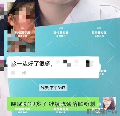臉上長閉口粉刺怎么去除,粉刺消下去了，皮膚變好了