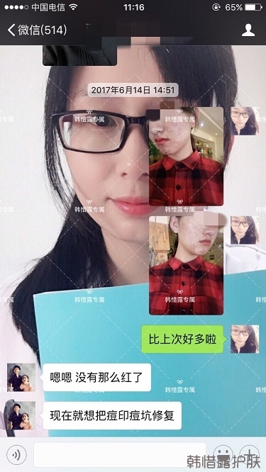 臉上長痘痘怎么去掉？徹底告別痘痘，自卑到自信的蛻變！