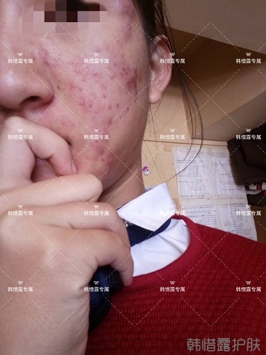 臉上長痘痘怎么去掉？徹底告別痘痘，自卑到自信的蛻變！
