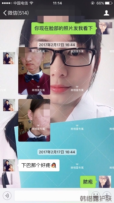 臉上長痘痘怎么去掉？徹底告別痘痘，自卑到自信的蛻變！