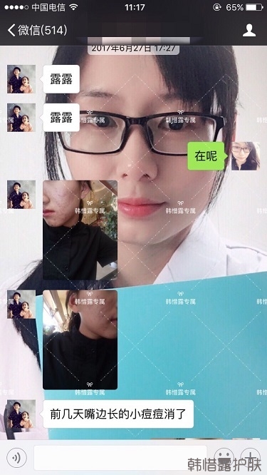臉上長痘痘怎么去掉？徹底告別痘痘，自卑到自信的蛻變！