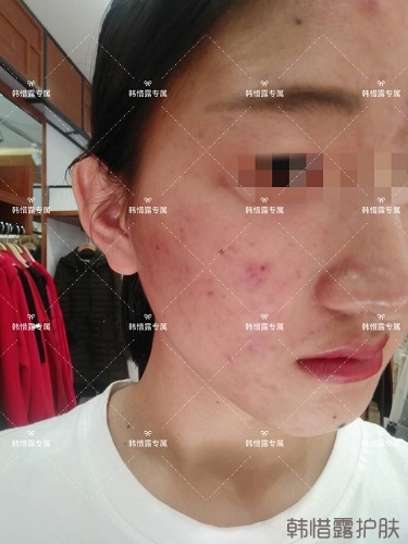 臉上長痘痘怎么去掉？徹底告別痘痘，自卑到自信的蛻變！