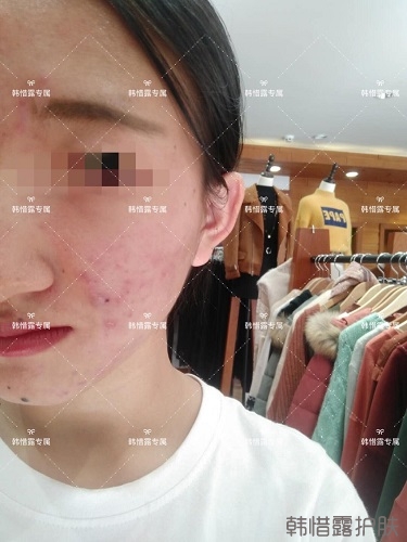 臉上長痘痘怎么去掉？徹底告別痘痘，自卑到自信的蛻變！