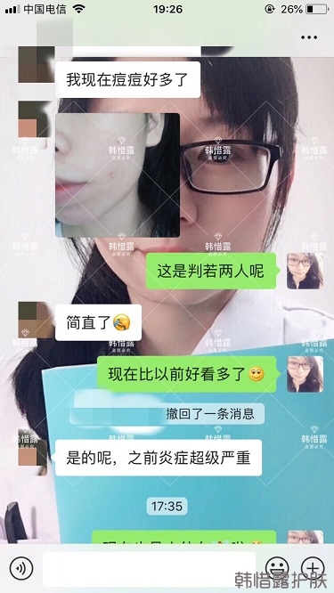 祛痘后判若兩人，膿包痘消了變小仙女