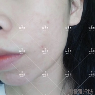 祛痘后判若兩人，膿包痘消了變小仙女
