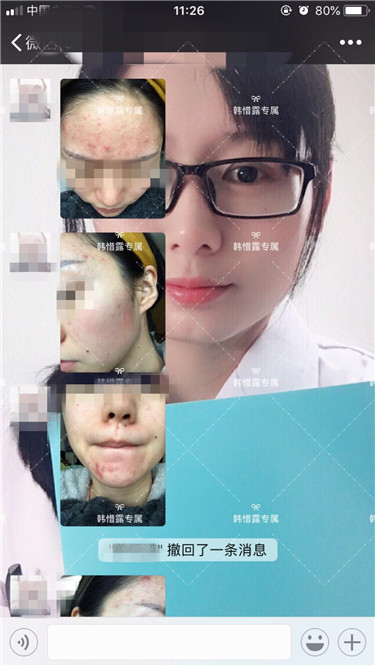 【視頻】臉上長粉刺怎樣去掉？醫院都沒搞定韓惜露幫我搞定了，超級開心！