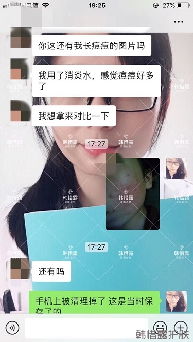 祛痘后判若兩人，膿包痘消了變小仙女