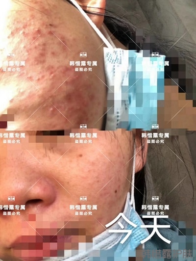 臉上長閉口粉刺怎么去除,粉刺消下去了，皮膚變好了