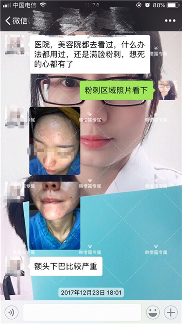 【視頻】臉上長粉刺怎樣去掉？醫院都沒搞定韓惜露幫我搞定了，超級開心！