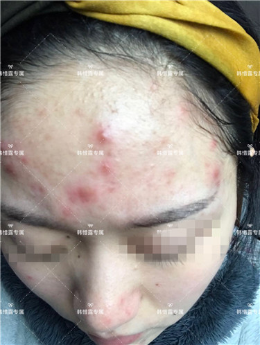 【視頻】臉上長粉刺怎樣去掉？醫院都沒搞定韓惜露幫我搞定了，超級開心！