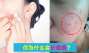 臉上長(zhǎng)痘痘是什么原因？請(qǐng)問(wèn)主要是什么原因呢？