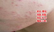 臉上長粉刺去粉刺的方法!不可錯(cuò)過的去痘痘粉刺變美機(jī)會！
