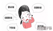 如何快速祛痘的方法？